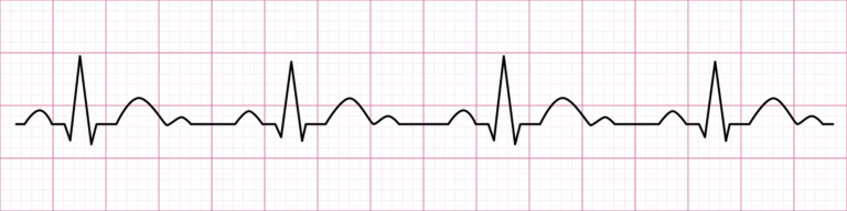 courbe cardiaque - cohérence cardiaque